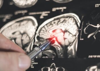 AI helps neurologists distinguish epilepsy from functional seizures