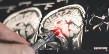 AI helps neurologists distinguish epilepsy from functional seizures