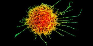 Patient Deaths and Data Shortfall Spell the End for Cell Therapy Biotech Artiva