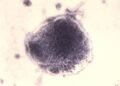 Pennsylvania reports its 6th measles death, in a Franklin County resident