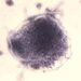 Pennsylvania reports its 6th measles death, in a Franklin County resident Pennsylvania reports its 6th measles death, in a Franklin County resident