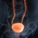 Simple urine test can accurately diagnose and track bladder cancer Simple urine test can accurately diagnose and track bladder cancer