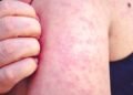 With Pennsylvania leading the way, US measles cases top 4,000