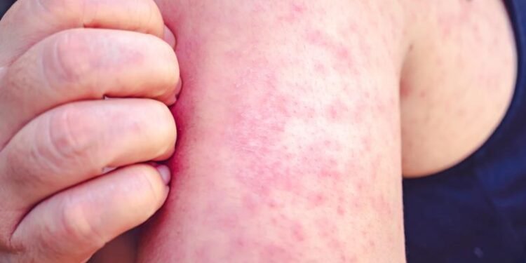 With Pennsylvania leading the way, US measles cases top 4,000 With Pennsylvania leading the way, US measles cases top 4,000