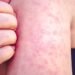 With Pennsylvania leading the way, US measles cases top 4,000 With Pennsylvania leading the way, US measles cases top 4,000